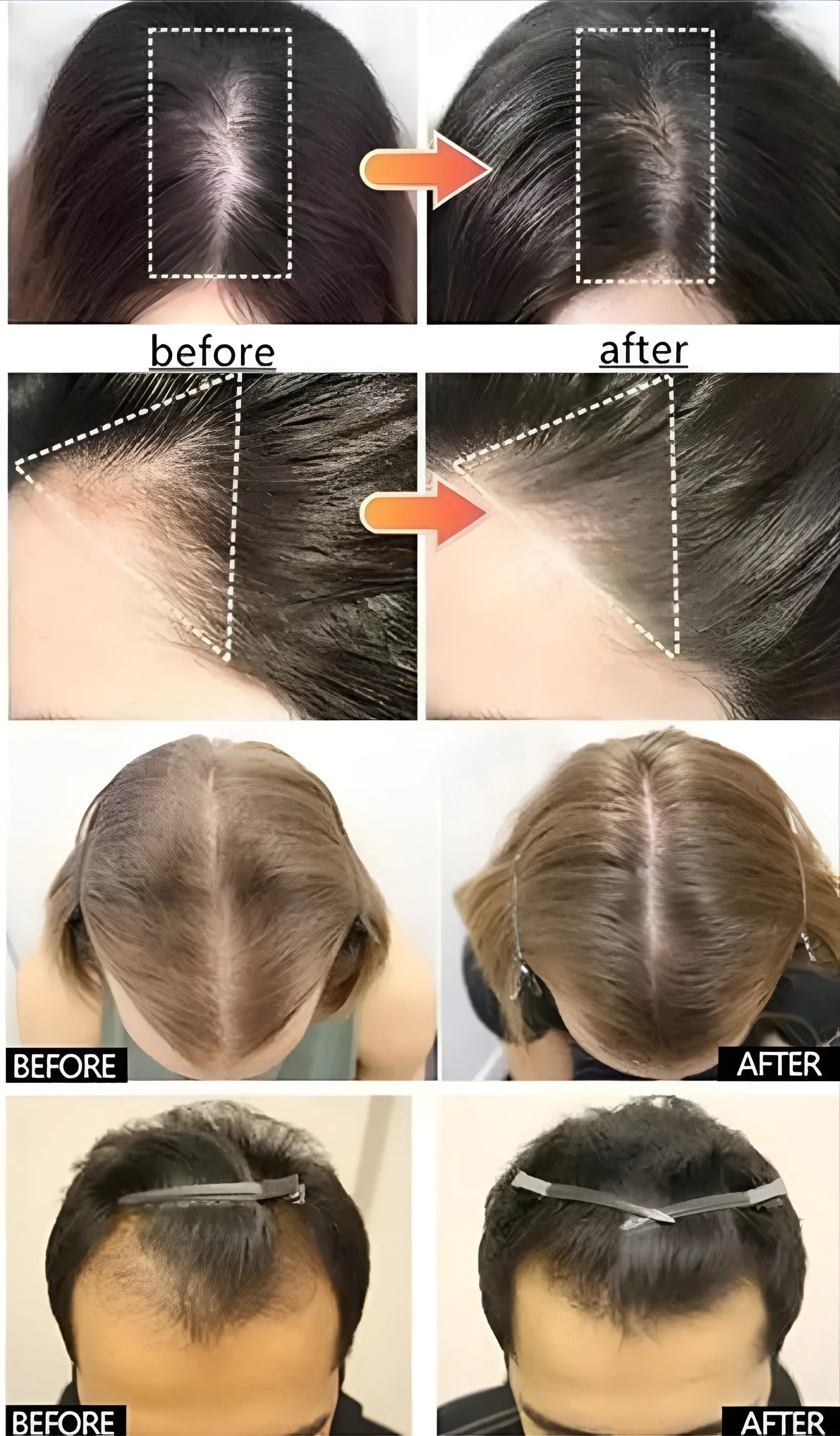 Before and After Hair care LED Therapy Comb real results